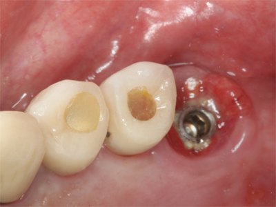 Calcemia exame
